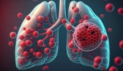 Pneumonia