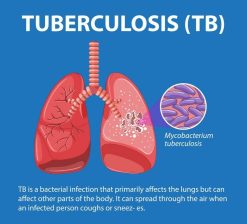 Tuberculosis